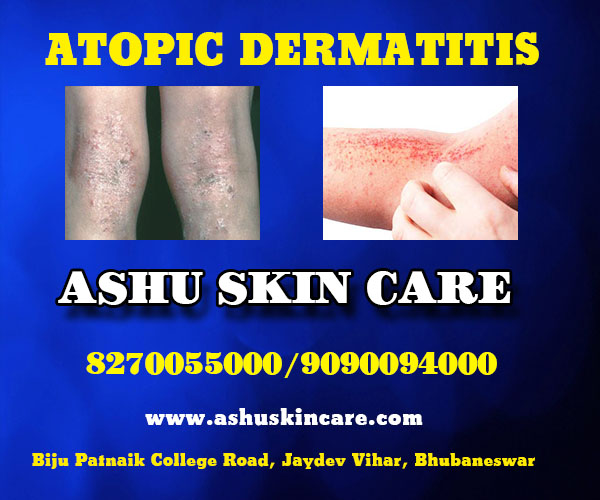 best atopic dermatitis treatment clinic in bhubaneswar close to apollo hospital
